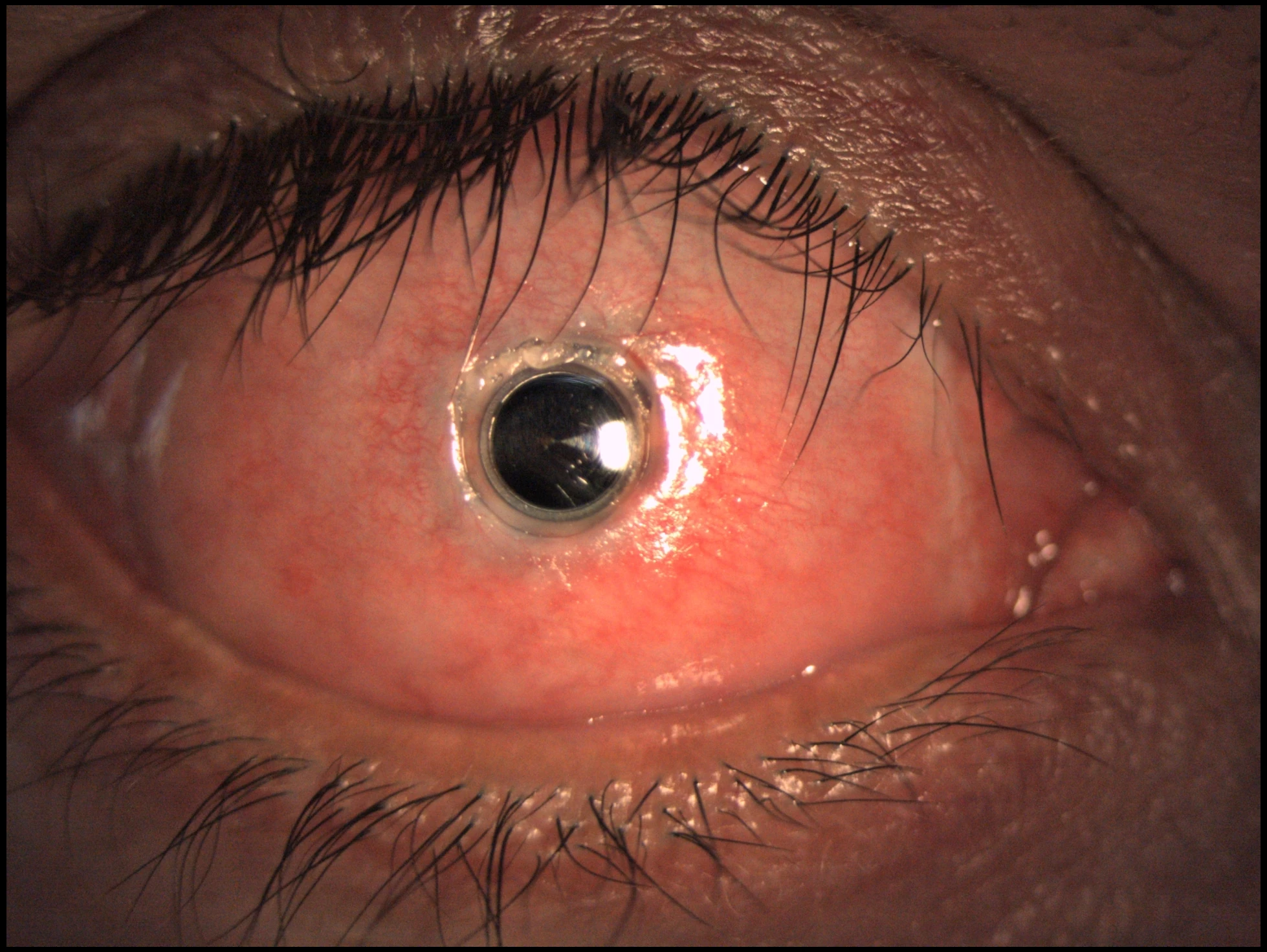Boston keratoprosthesis with buccal mucosa frontal clinical image